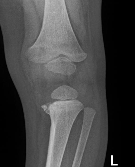 Case courtesy of Dr. Basab Bhattacharya, Radiopaedia.org. From the case Non-Accidental Injuries