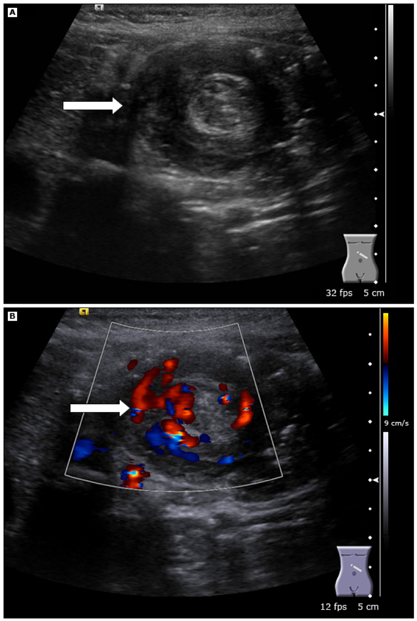Figure 2: Ultrasound image of intussusception