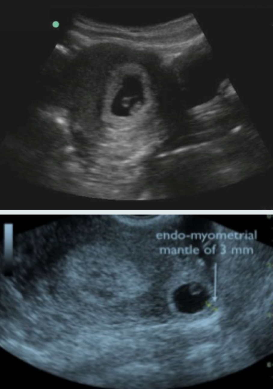 9 Week Ectopic Pregnancy Ultrasound
