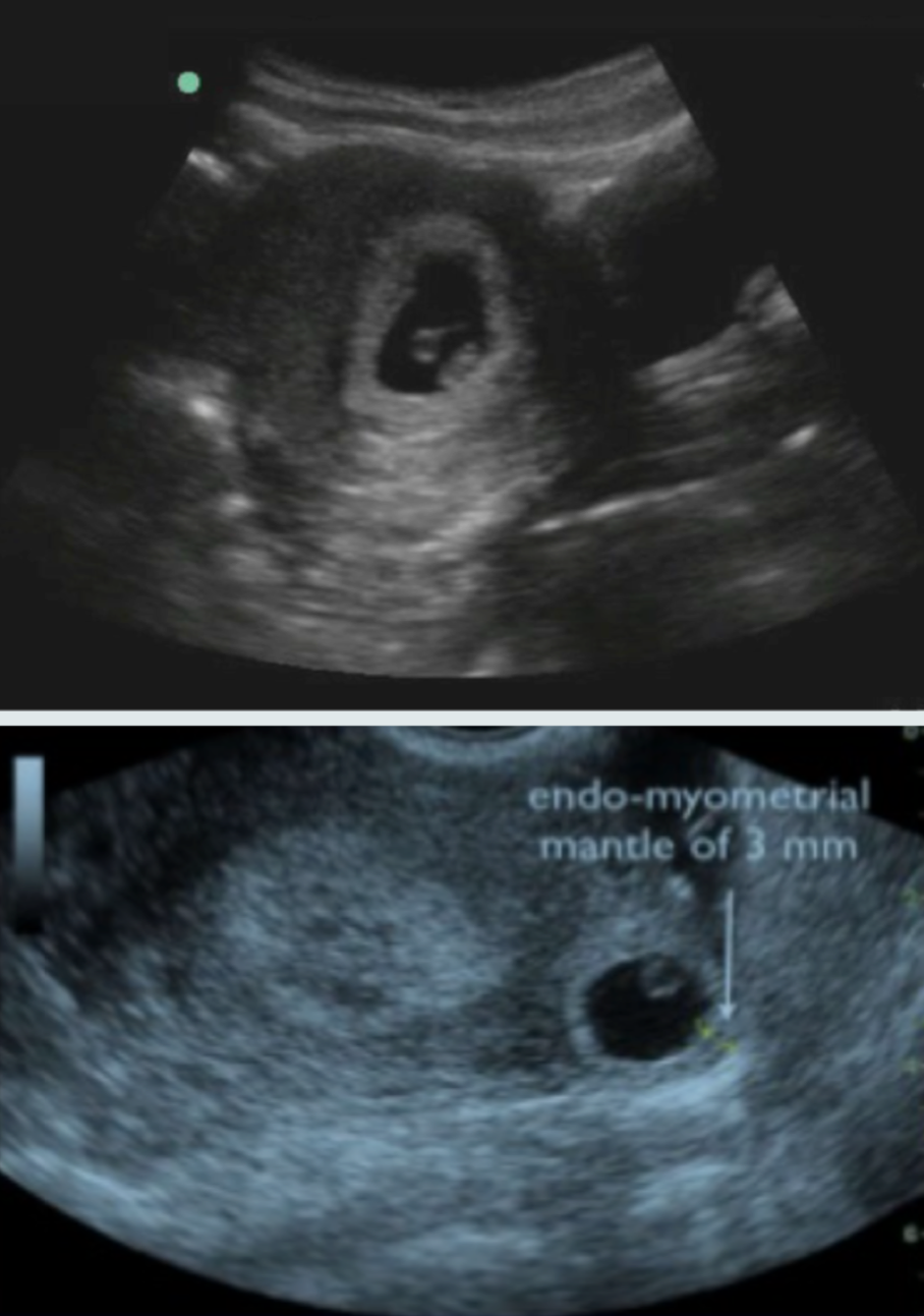 ectopic-pregnancy-ultrasound