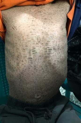 Tales From Honduras – Ichthyosis, An Unusual Skin Finding