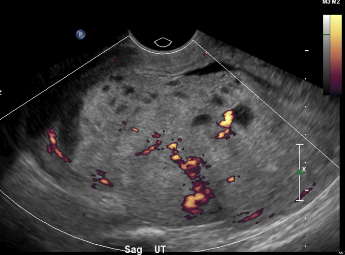Ultrasound Case of the Month: Hydatidiform Mole — BROWN EMERGENCY MEDICINE