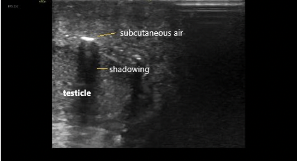 Brown Sound: Necrotizing Soft Tissue Infection