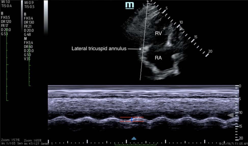Hennepin Ultrasound  Right Ventricular Strain in Pulmonary Embolism