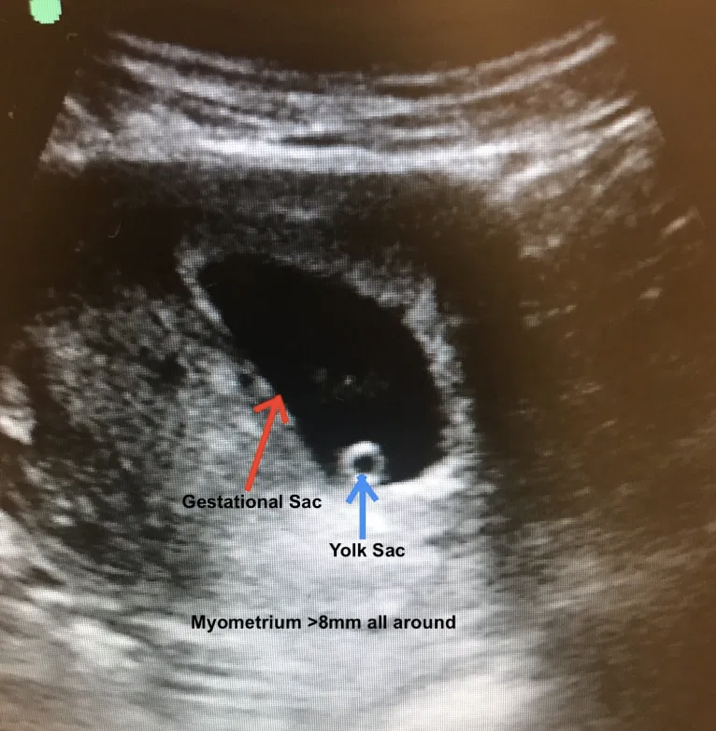 Figure 2. First-trimester IUP with gestational sac and yolk sac within the uterine cavity. [6] In this scenario, we see a definitive IUP, and the patient was not on any infertility treatments, making the risk of a heterotopic pregnancy close to zero. Other considerations here include evaluation of the   endomyometrial mantle  , or the full thickness of the endometrium and myometrium combined. A thickness ≥ 8 mm is considered normal, with &lt; 5 mm concerning for interstitial pregnancy.[7]