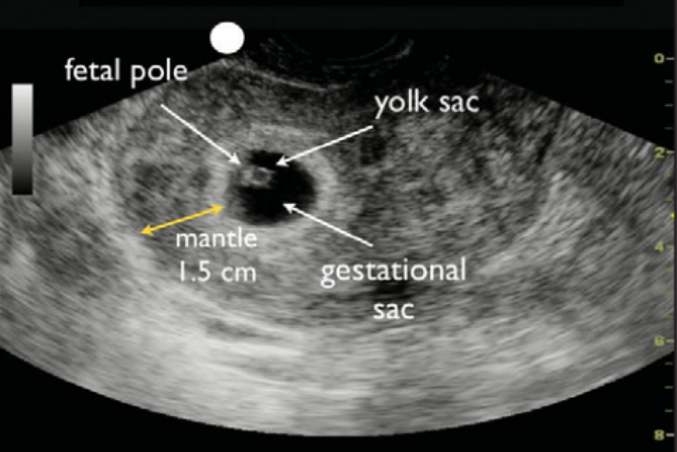 Figure 3. First-trimester IUP with thick endomyometrial mantle. [8]