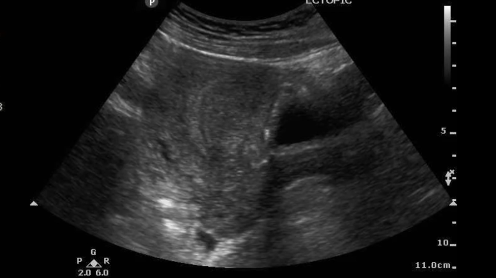 Figure 4. No intrauterine pregnancy visualized.