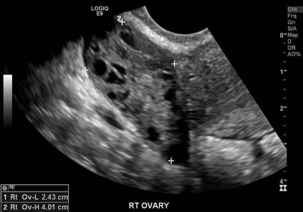 Ultrasound: Ovarian Torsion