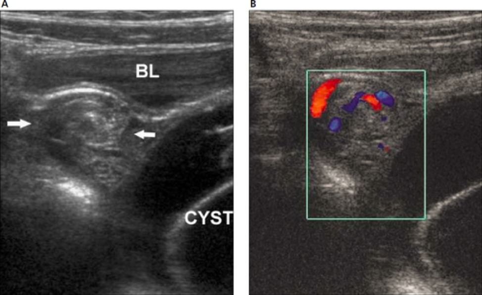Ultrasound Ovarian Torsion BROWN EMERGENCY MEDICINE
