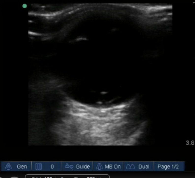 Figure 1: Ocular POCUS showing circular ring shaped hyperechoic area in the posterior chamber.