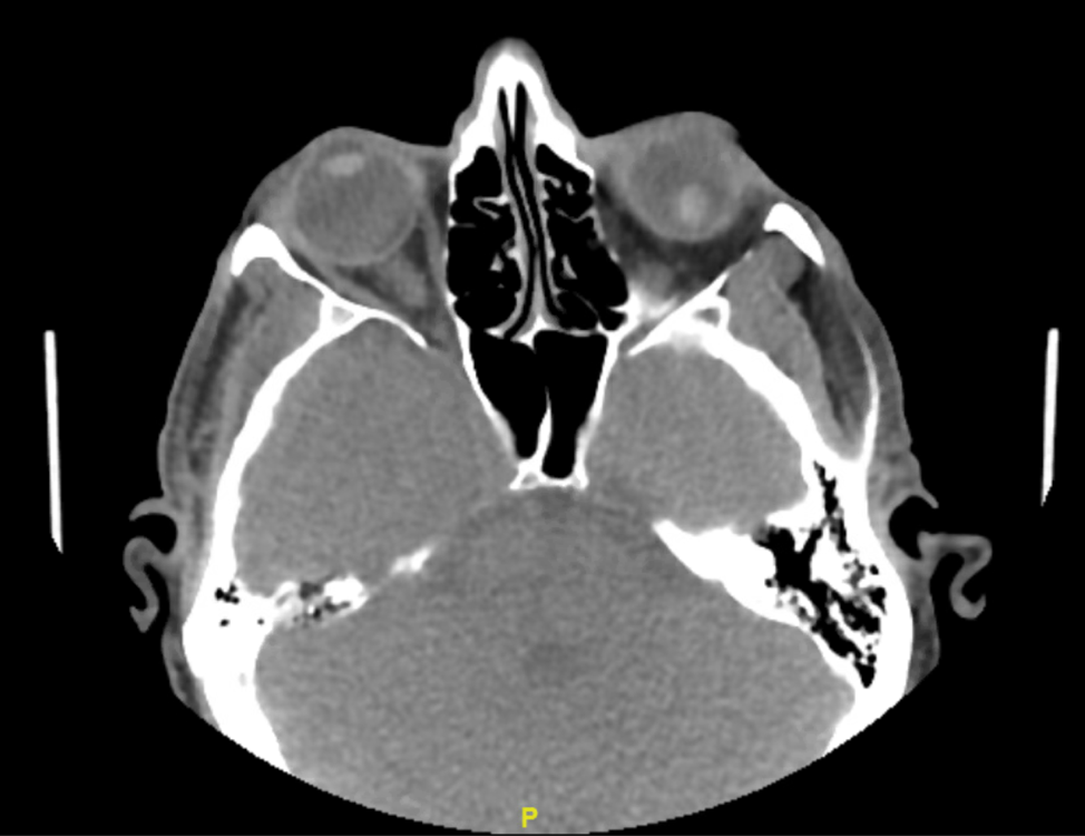 Figure 2: CT face with confirmation of lens detachment