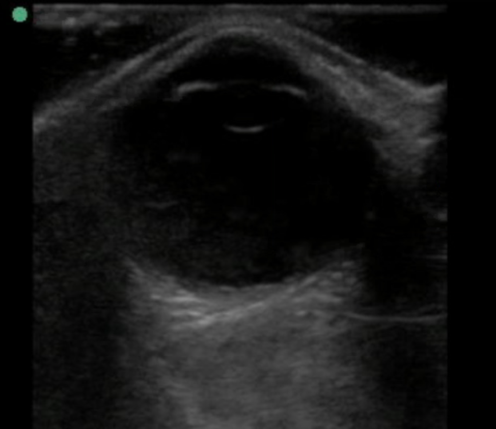 Figure 3: Ocular POCUS with normal lens location