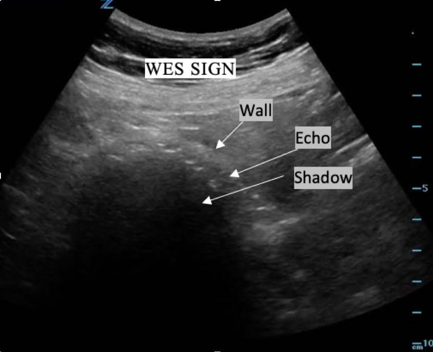 Megalopolis perspective favorite Avoiding a Pitfall of Biliary Ultrasound: Understanding Wall-Echo-Shadow  (WES) Sign — BROWN EMERGENCY MEDICINE