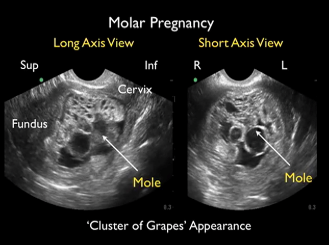 Molar Pregnancy: Diagnosis of Hydatidiform Mole Using Bedside Emergency Ultrasound