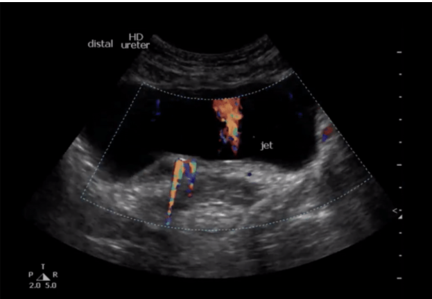 Image 4: Stone in the UVJ (on the left of the screen you see twinkle artifact from the UVJ stone and on the right you see ureteral jets, indicating no obstruction on the right side of screen)