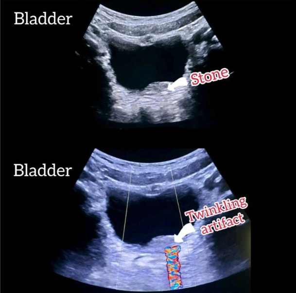 Image 3: Twinkle artifact occurs when color doppler is placed over a stone
