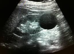Image 2: Kidney Cyst. Anechoic (black) structure is in the periphery (cortex), not in the renal pelvis. Simple cysts are round and anechoic without internal septations