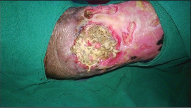 Wound Myiasis Management: What Works, What Doesn't — BROWN EMERGENCY  MEDICINE BLOG