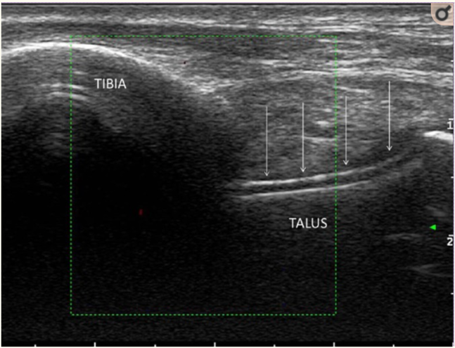A Flare in the ED: Using Ultrasound to Diagnose Gout