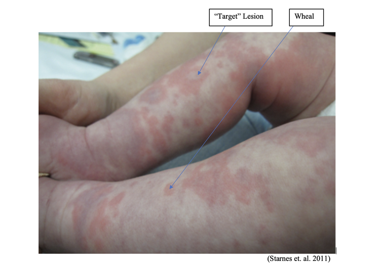 Targetoid Features Recognizing the Differential Diagnoses for Erythema Multiforme — BROWN ...