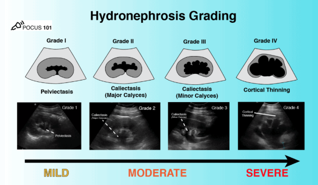 Image 1: Hydronephrosis Grading (mild involves pelvis, moderate involves calyces, severe involves cortex)