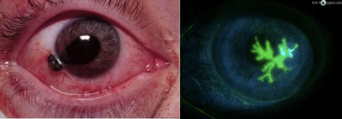 Corneal Abrasion Fluorescein Delayed Corneal Healing After The Use Of Corneal Abrasion Fluorescein Delayed Corneal Healing After The Use Of