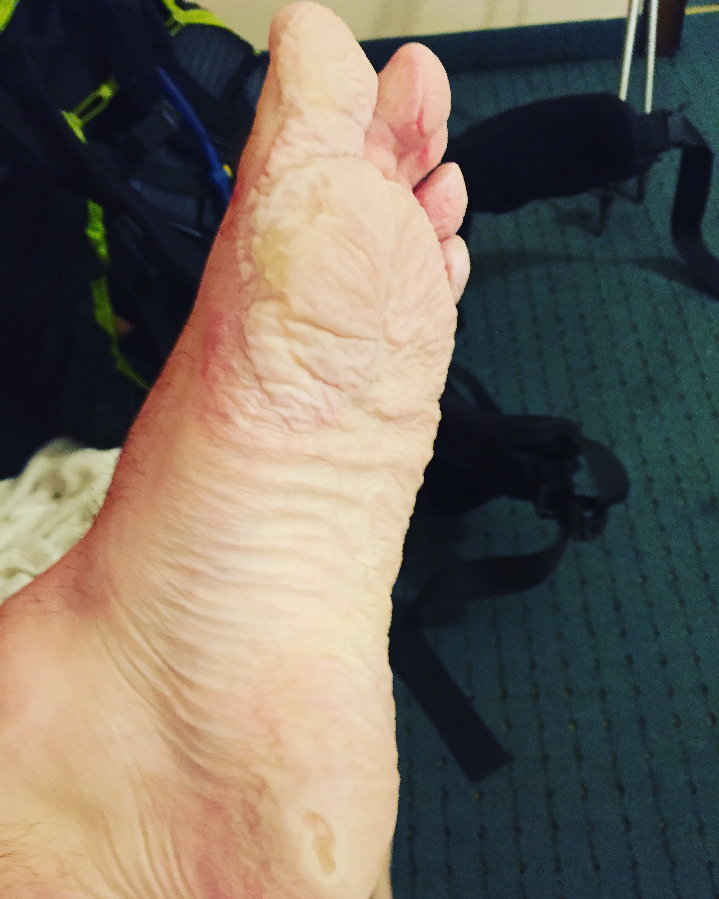 Trench foot is never a fun time.