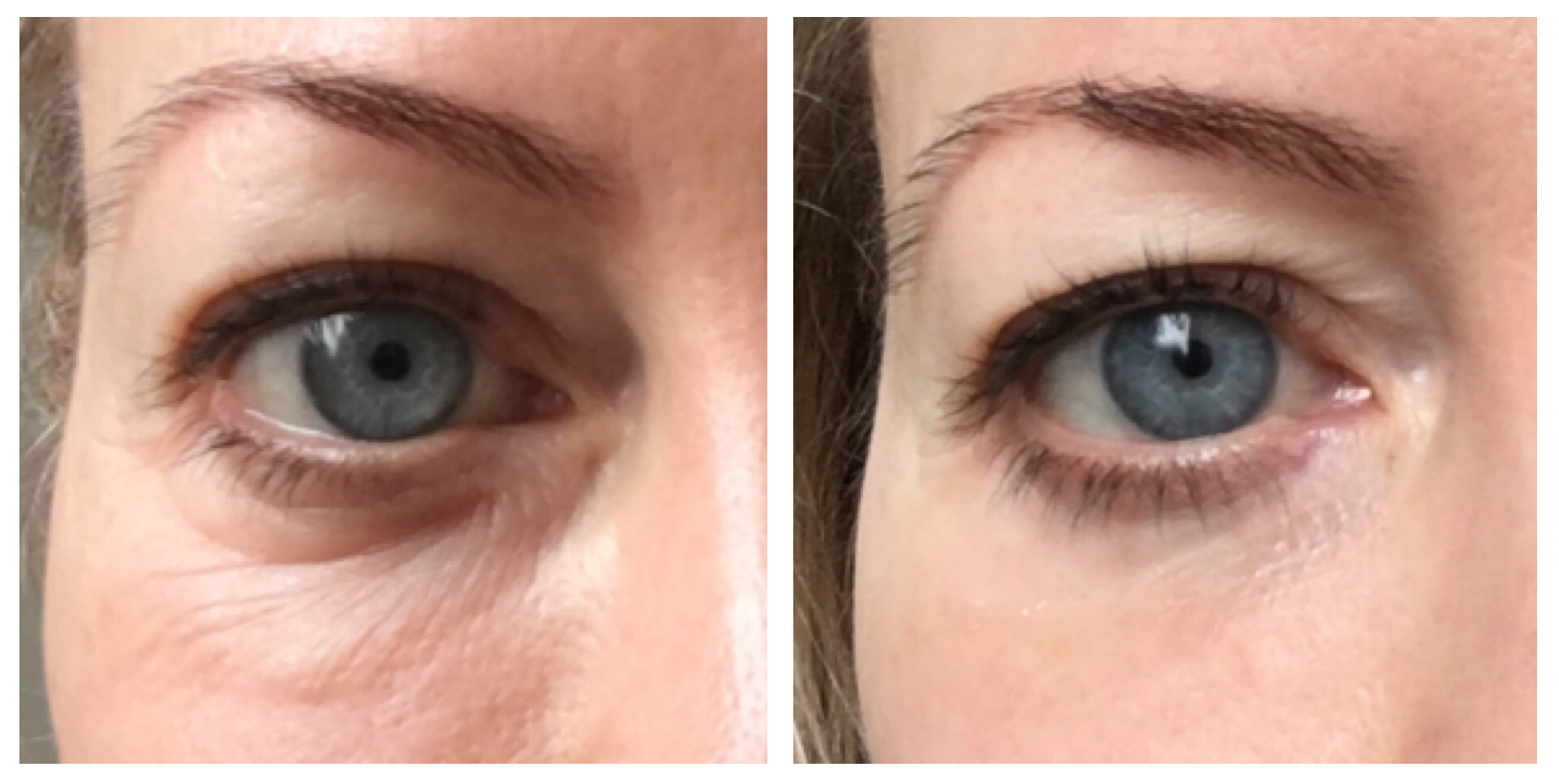 Now you see it, now you don't: my right eye before (left) and after using My Perfect Eyes serum