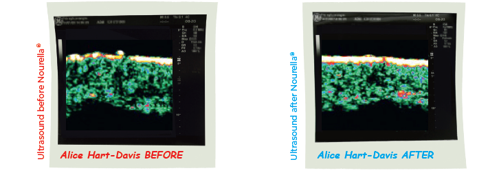 What the ultrasound scan showed after four months of using Nourella