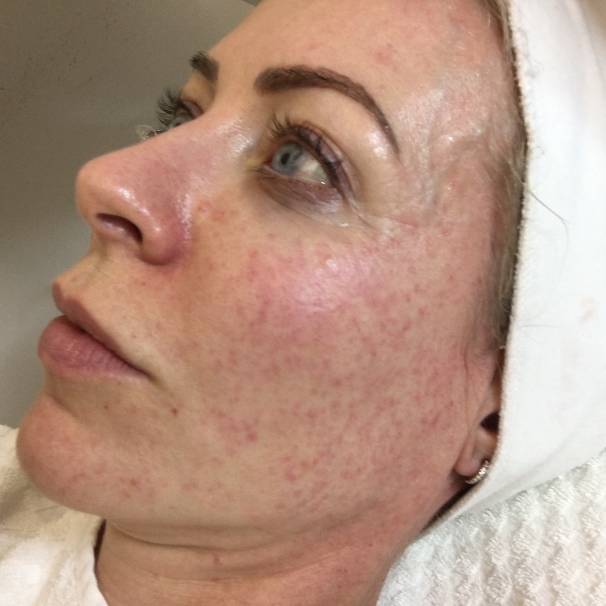 After mesotherapy - yes, my skin does look a bit stung up...