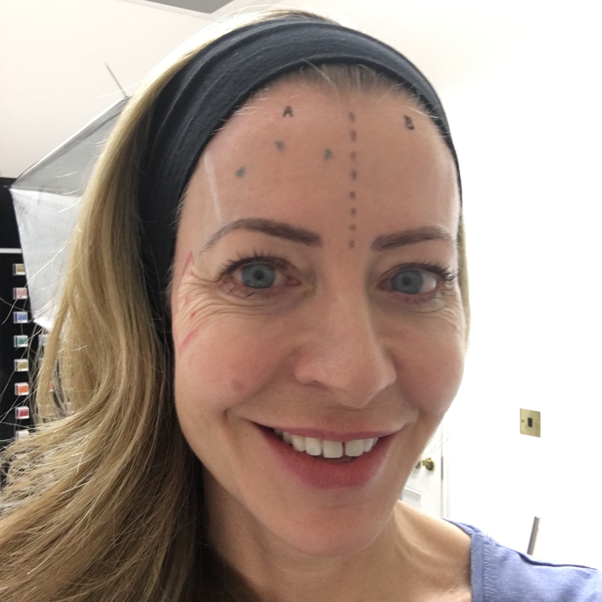 When the cosmetic doctor marks up just half your face for Botox