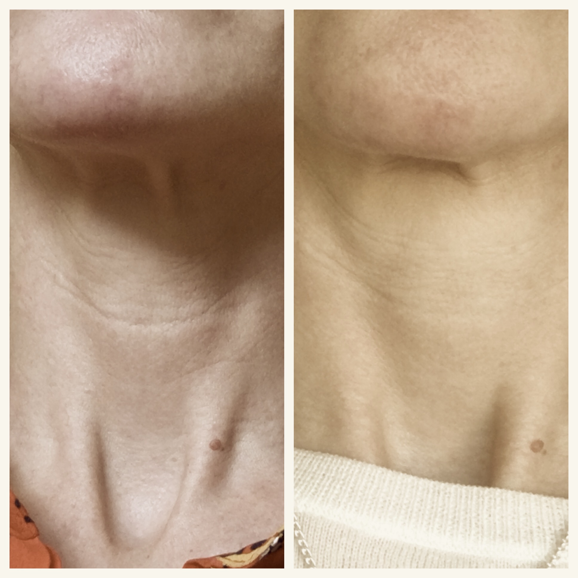 My neck before (left) and after treatment. The light's not the same, but you can see the change