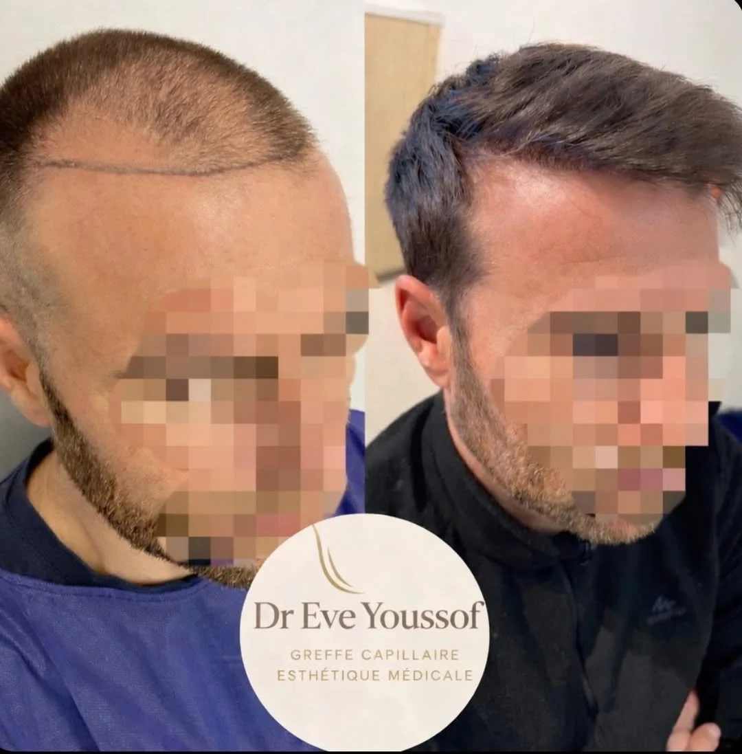 greffe de cheveux FUE marseille photos de résultats