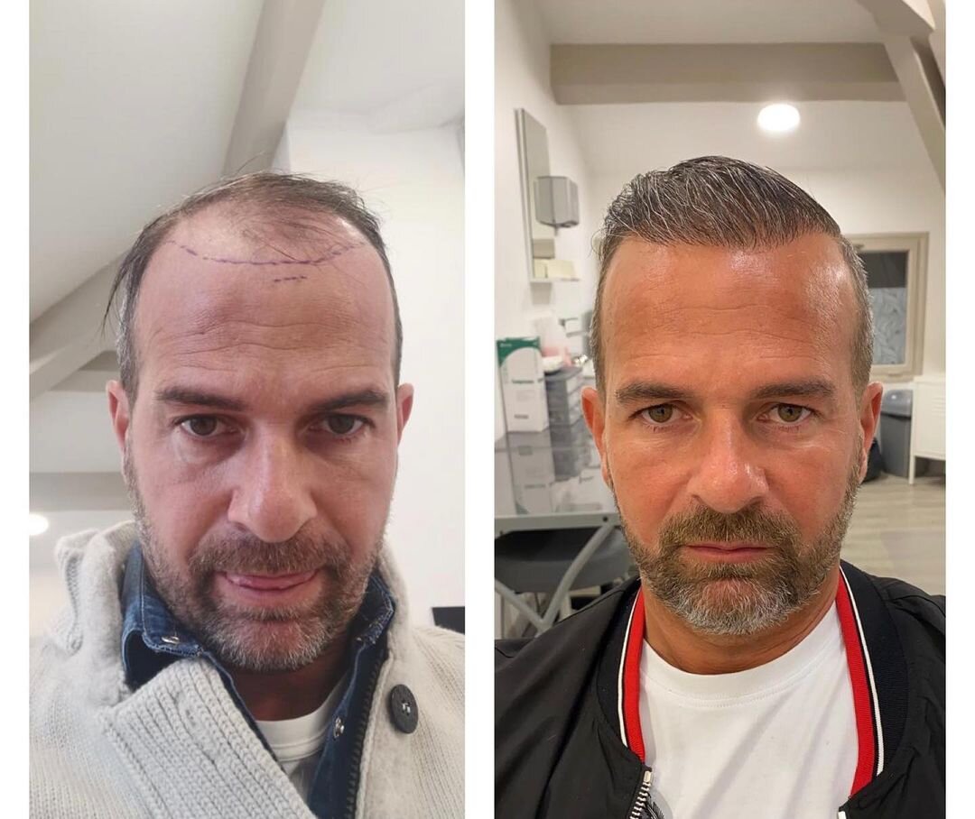 Implants capillaires : photos avant / après - dr eve youssof