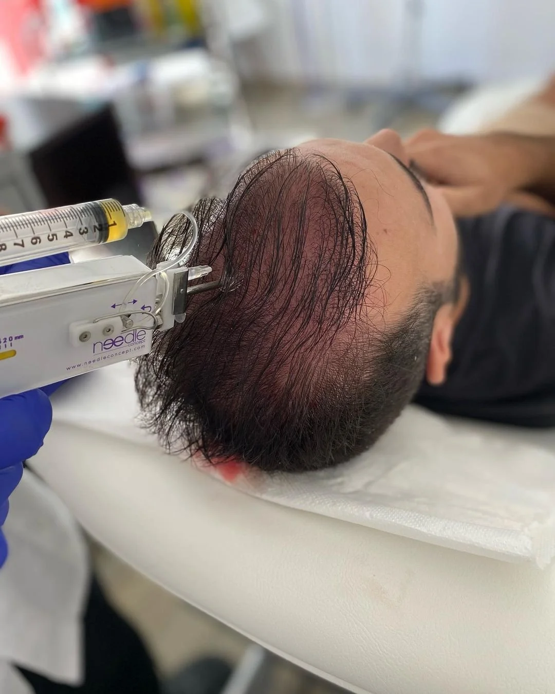 La greffe de cheveux par Extraction d'Unités Folliculaires (FUE) vs les injections de Plasma Riche en Plaquettes (PRP)