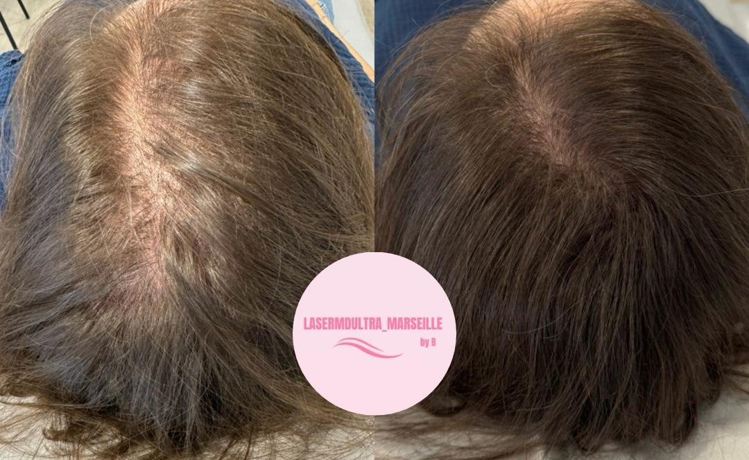 Chute de cheveux chez la femme