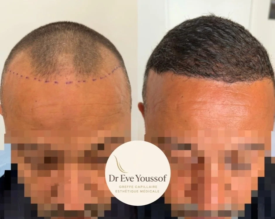 corriger une greffe de cheveux ratée