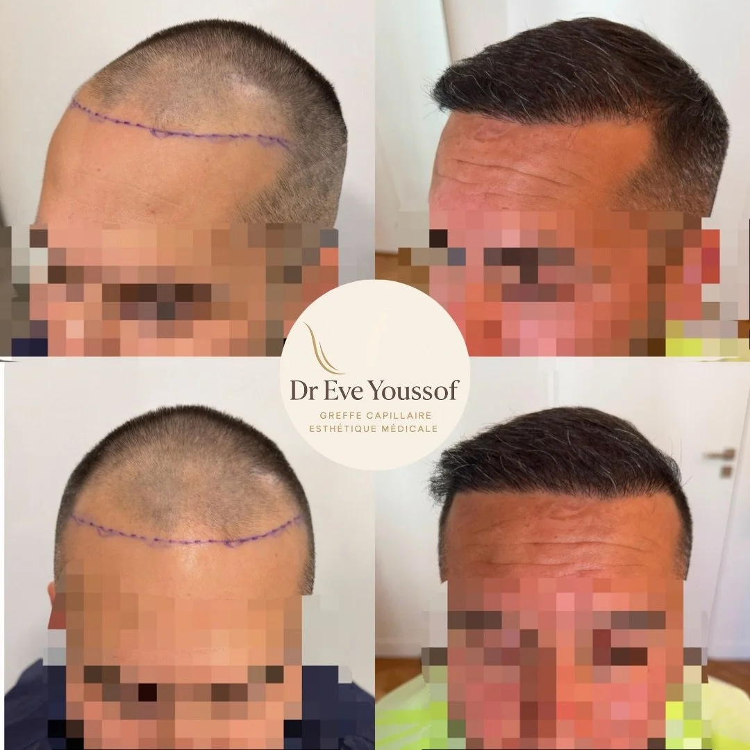 Greffe de cheveux : ligne frontale à 6 mois post greffe capillaire.