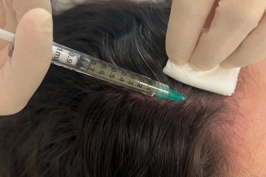 Traitement de la chute de cheveux par mésothérapie.jpg