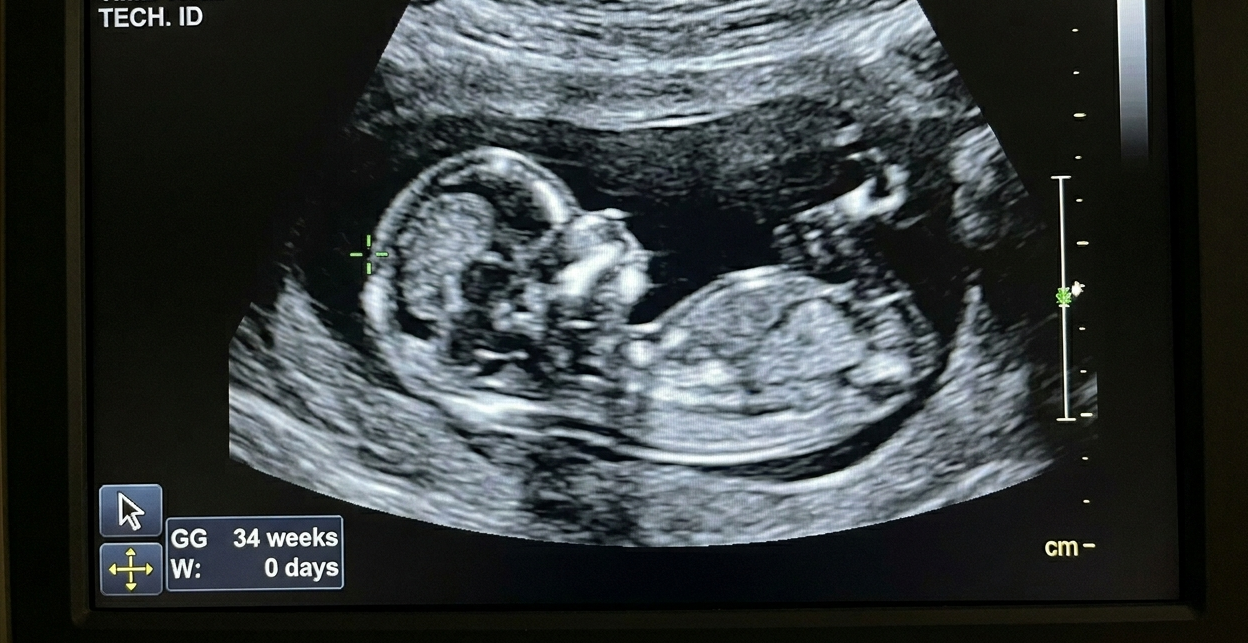 Turning Breech Babies with Moxibustion: A Natural Approach in Toronto