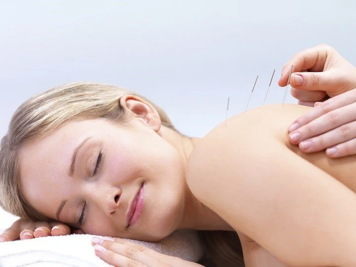 5 Reasons To Try Acupuncture