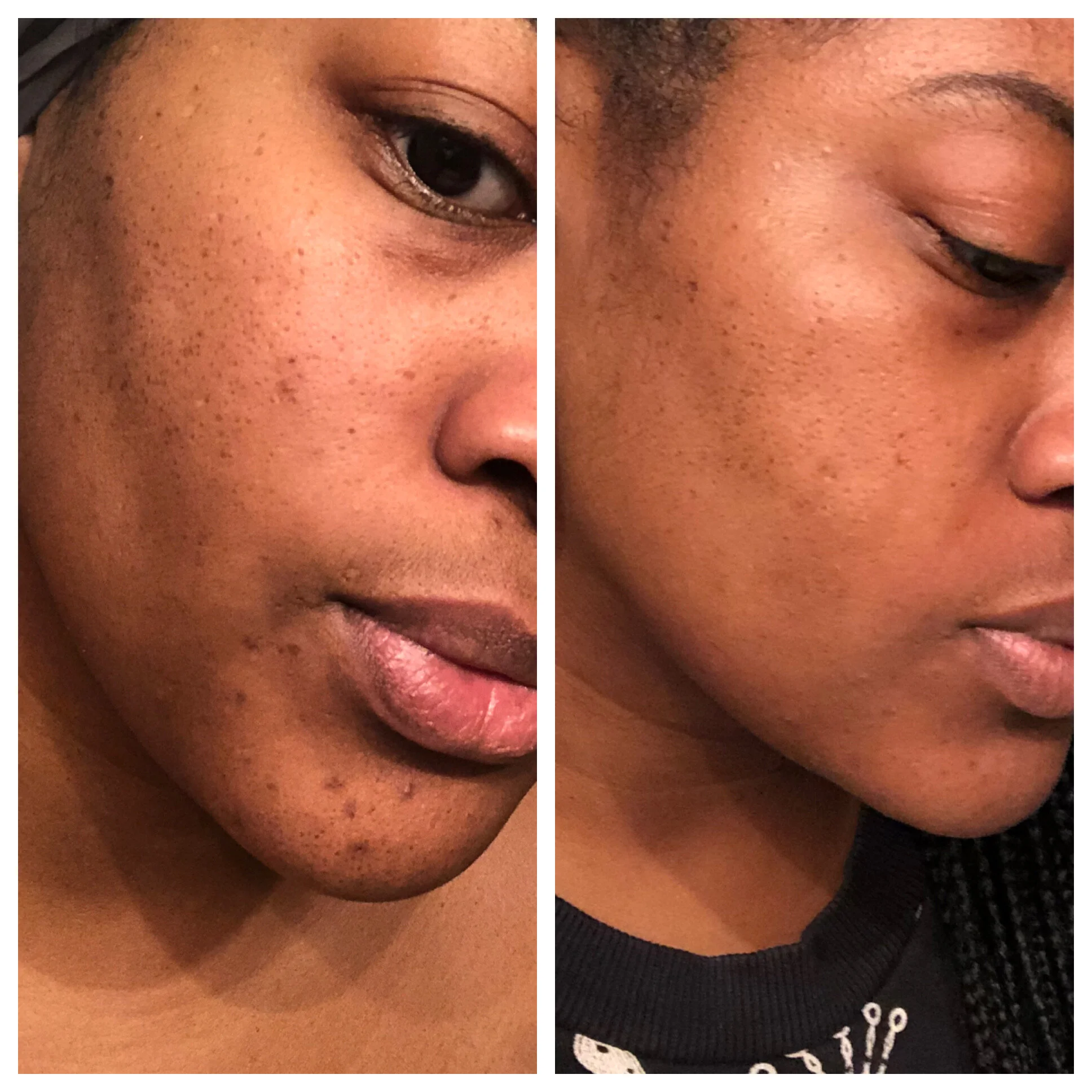 Before and After - The photo on the left was after I was getting a TON of cystic acne pimples on my chin and each one was swelling a bruising like crazy.
