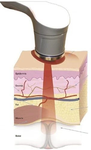 ONLY THE GENTOX HPHD LASER HAS THE POWER THAT AFTER REFLECTION, SCATTERING AND ABSORPTION, IT CAN STILL REACH BONE DEEP.