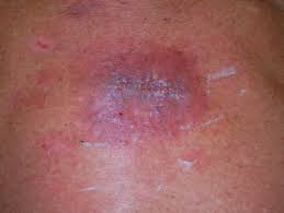 Derm infection.jpg