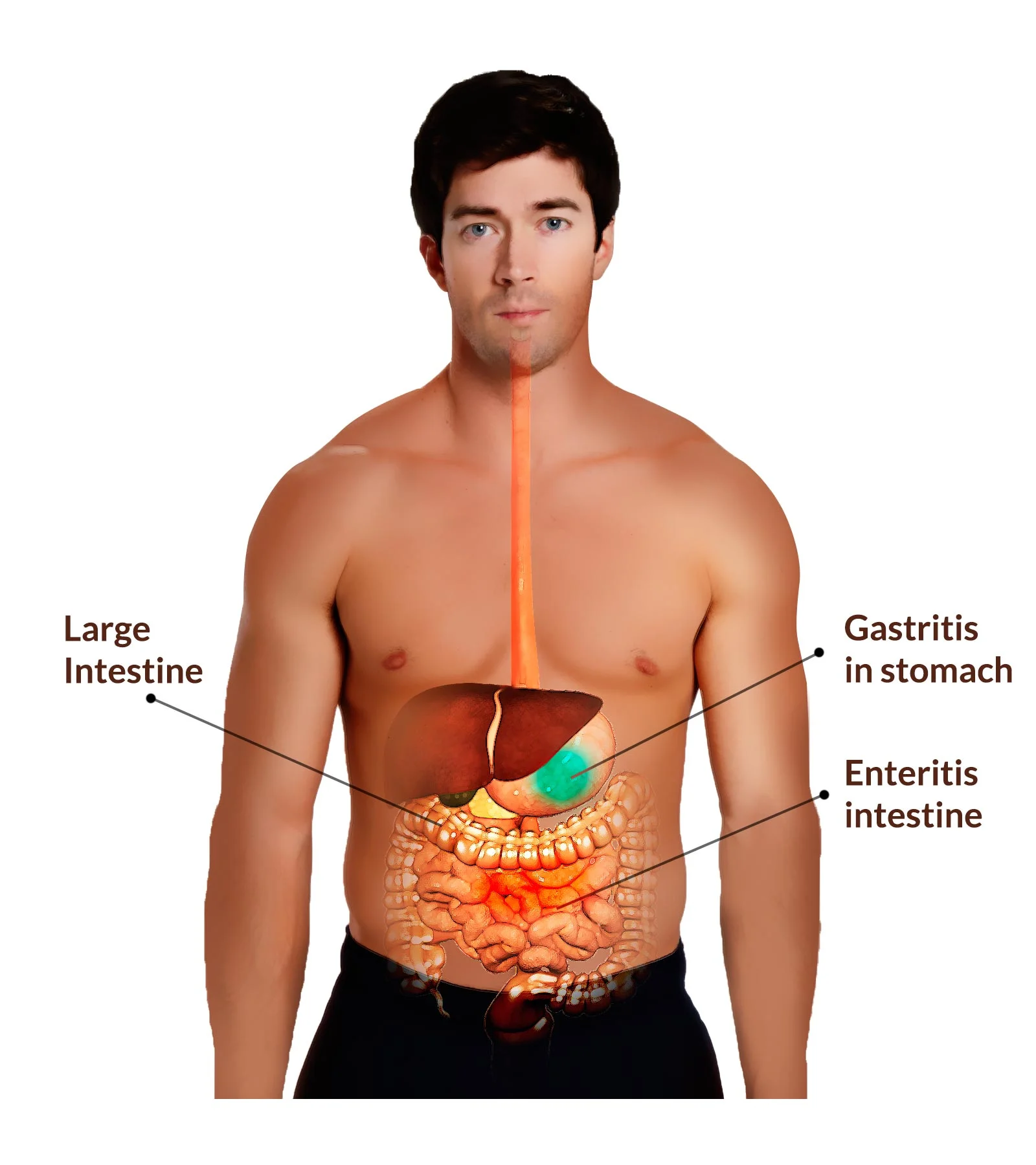 Gastroenteritis.jpg