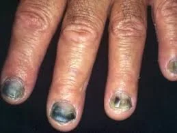 nail infection.jpg