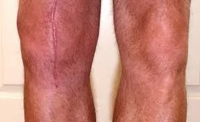 Ortho Infection.jpg