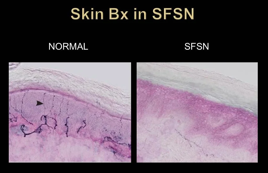 enfd-skin-punch-biopsy-testing-for-small-fiber-neuropathy-medworx