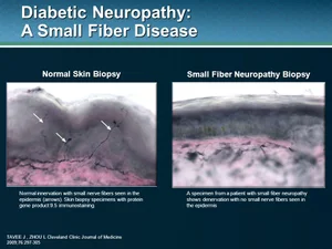 ENFD - Skin Punch Biopsy testing for Small Fiber Neuropathy — MedWORX ...