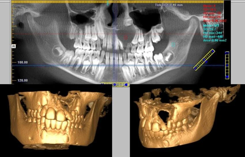 CBCT-is-more-successful-for-the-evaluation-of-the-periapical-lesion-and-bone-destruction.png